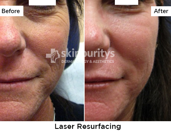 Laser Acne Scar Removal Before and After